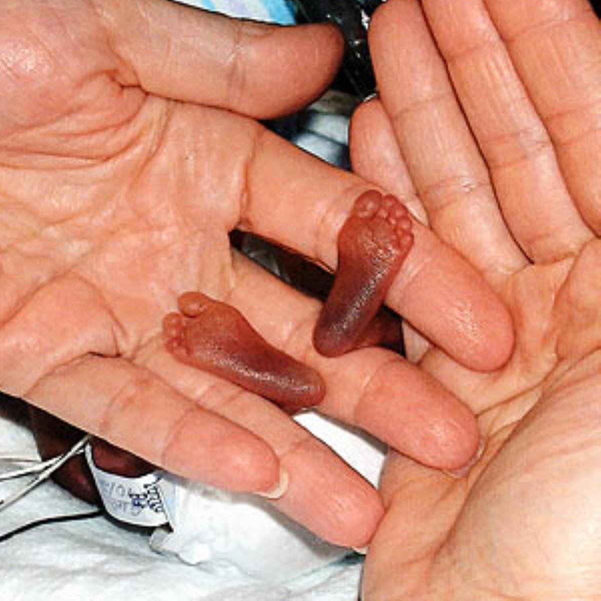 Kürtaj Nedir? Neden Yapılır? Kürtaj Sonrası Yapılacaklar Nelerdir?