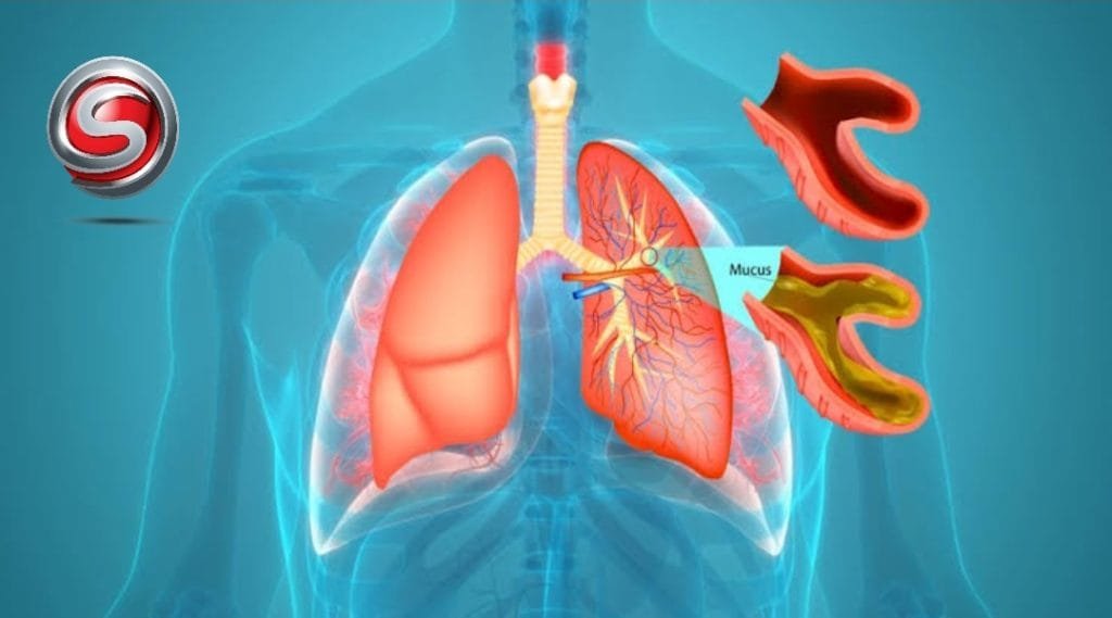 Bronşit Hastalığı: Belirtiler, Nedenler ve Tedavi