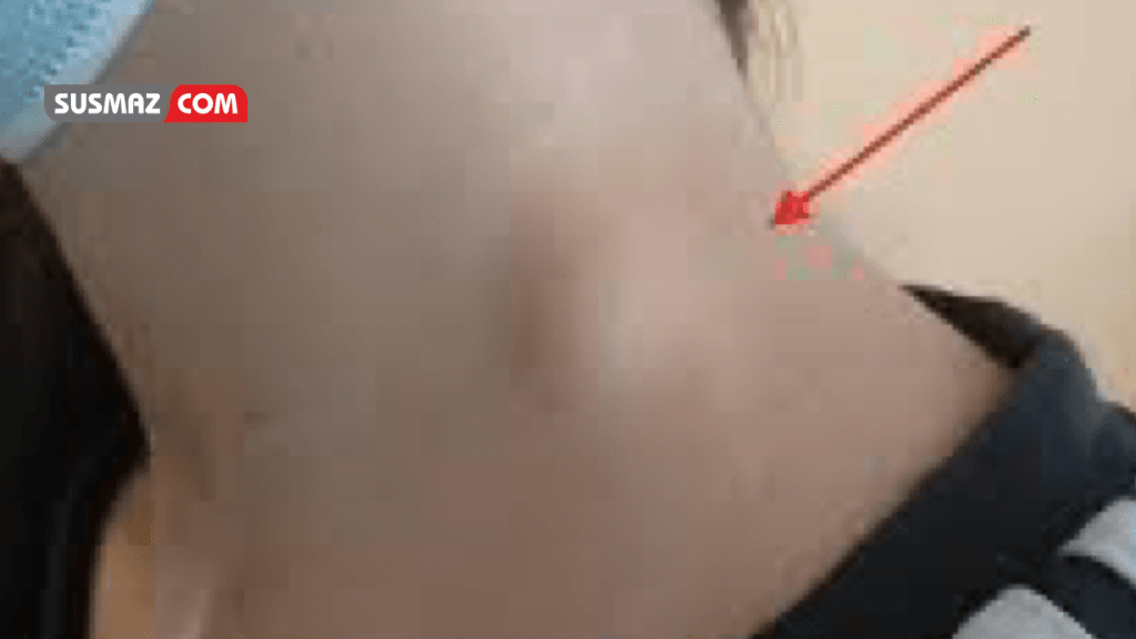 “Lenf Bezeleri Şişmesinin Nedenleri ve Etkili Tedavi Yöntemleri”